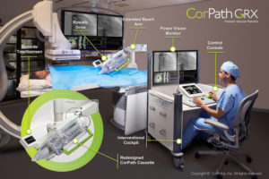 Corindus将CorPath GRX提交给FDA，用于机器人神经血管干预